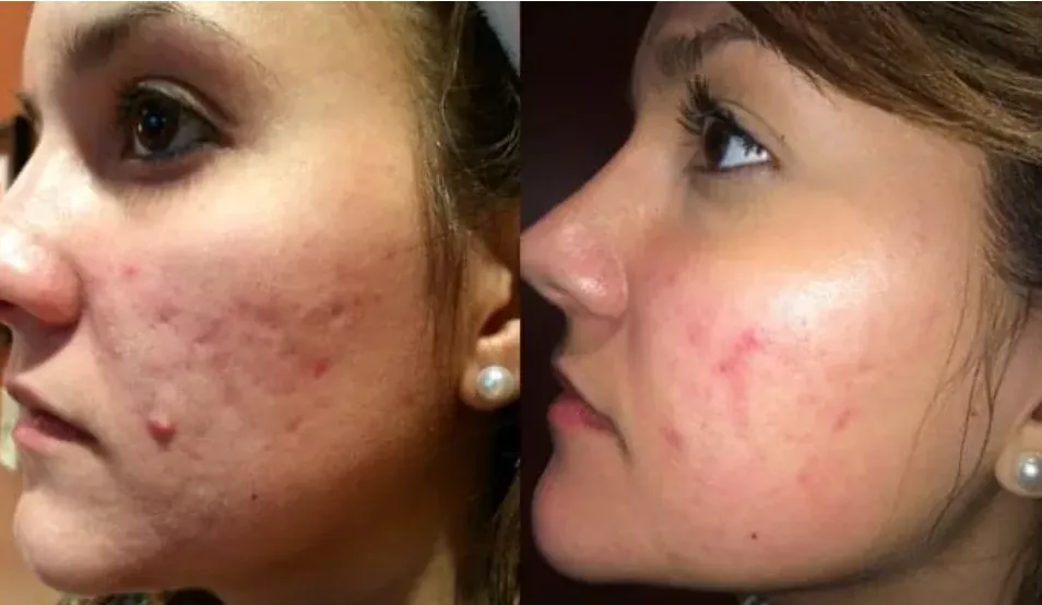 Renual Medspa microdermabrasion before and after