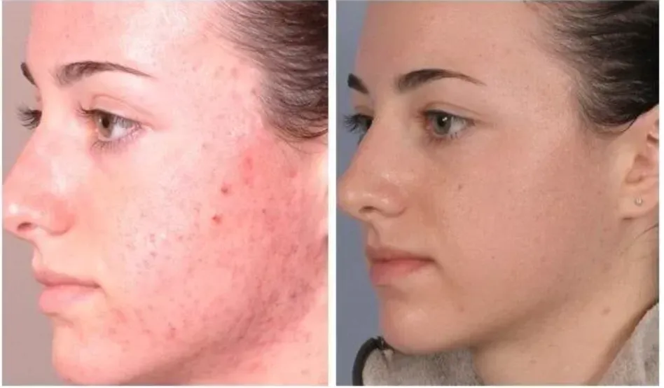 Renual Medspa microdermabrasion before and after