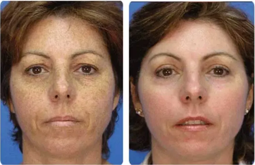 Renual Medspa microdermabrasion before and after