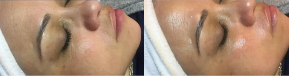 Renual Medspa defuzzinator before and after