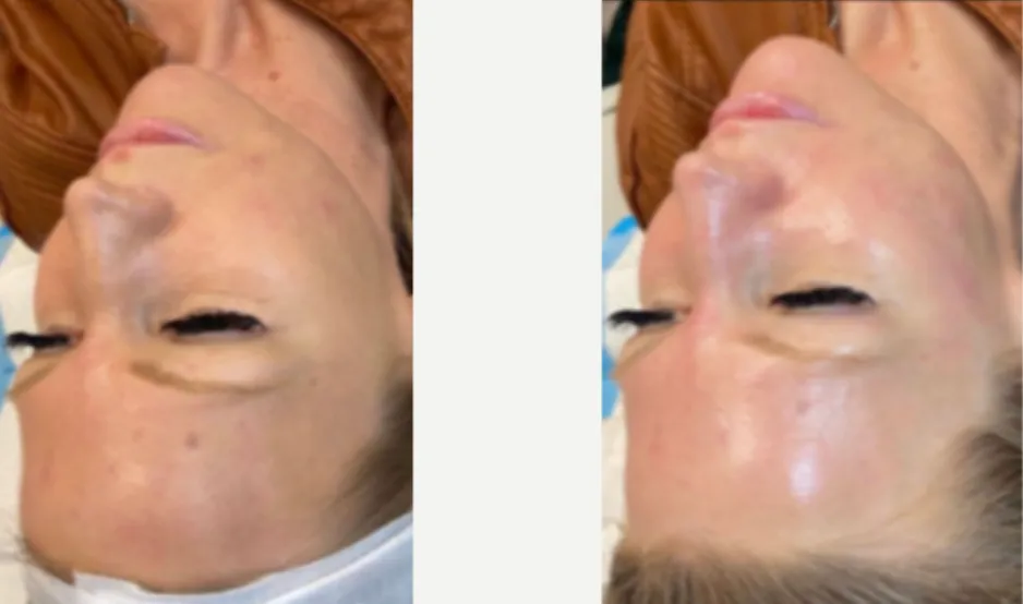 Renual Medspa defuzzinator before and after