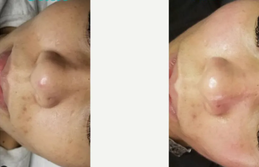 Renual Medspa defuzzinator before and after