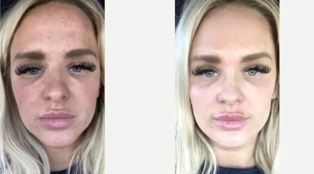 Renual Medspa defuzzinator before and after