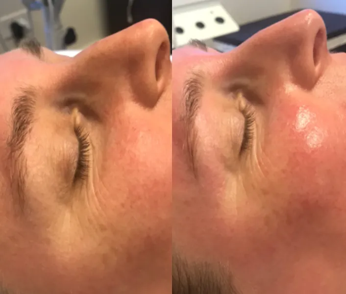 Renual Medspa defuzzinator before and after