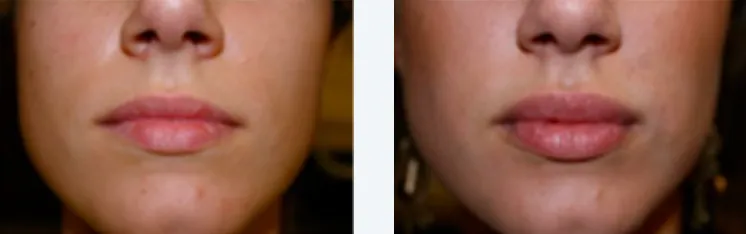 Renual Medspa botox and filler before and after
