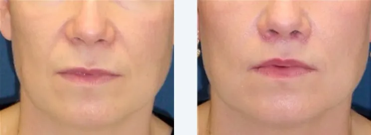 Renual Medspa botox and filler before and after