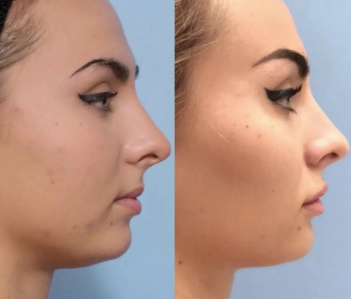 Renual Medspa botox and filler before and after