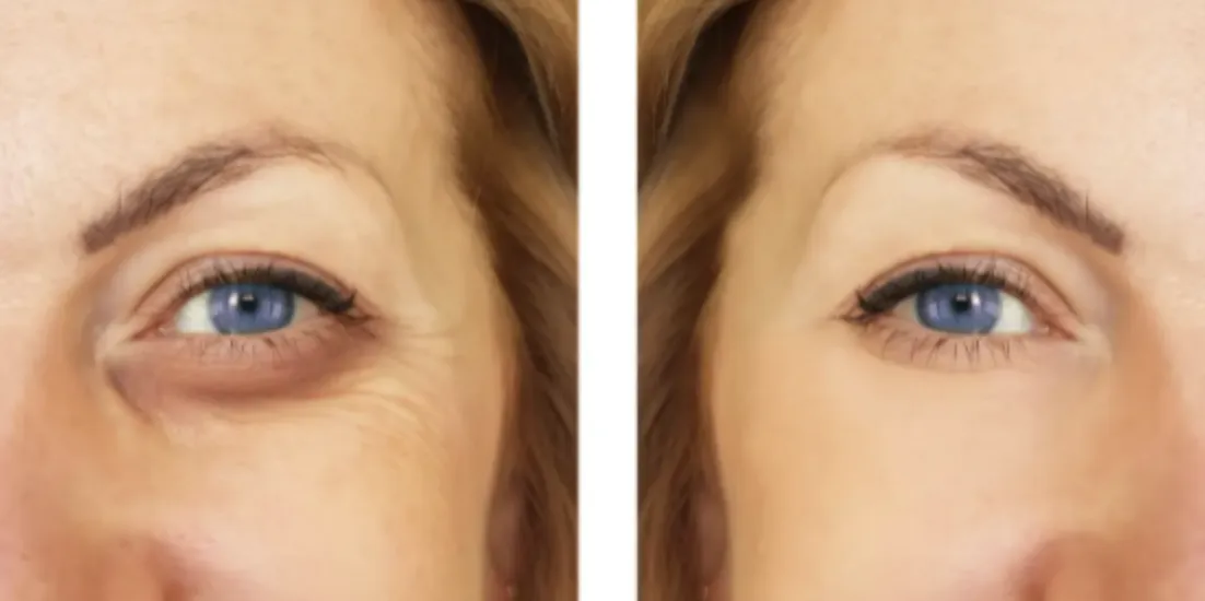 Renual Medspa botox and filler before and after