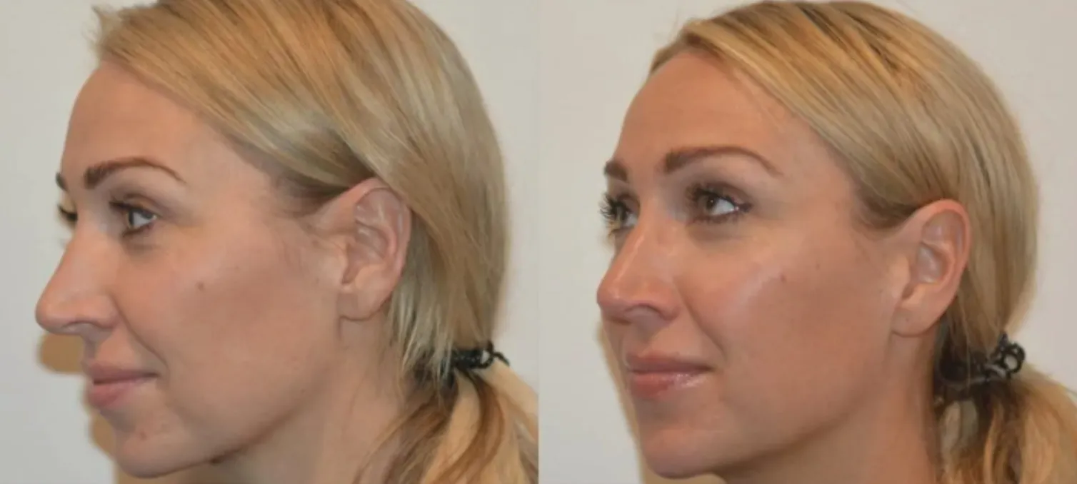 Renual Medspa botox and filler before and after