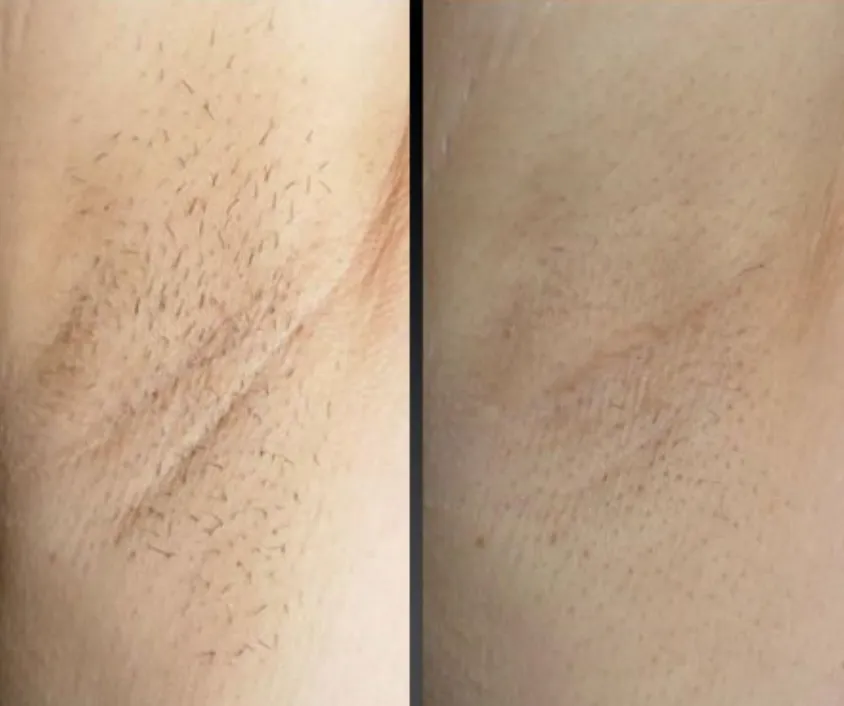 Renual Medspa laser hair removal before and after