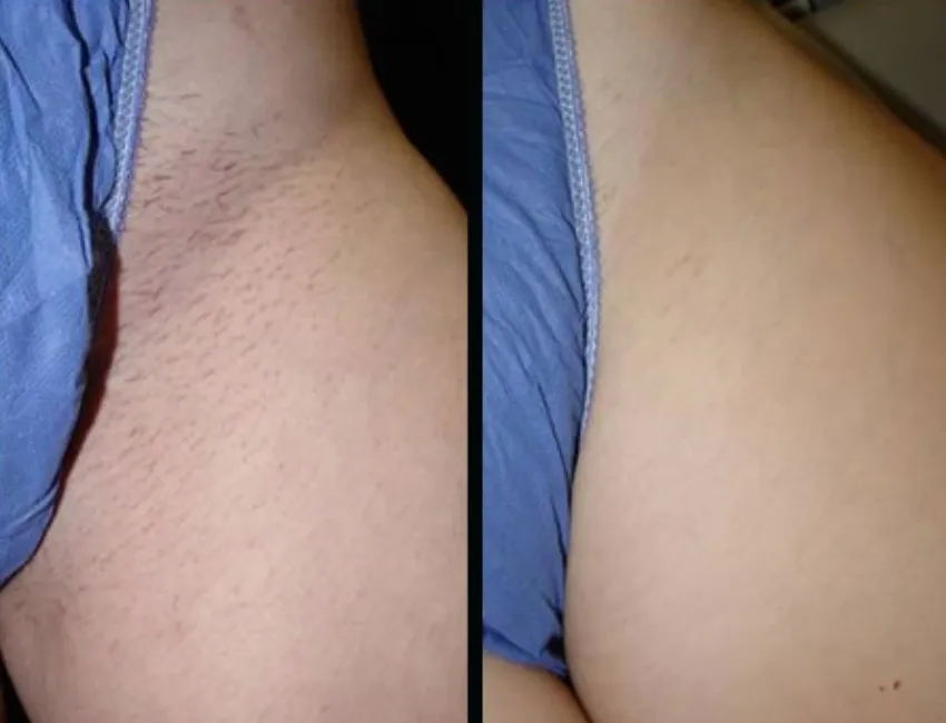 Renual Medspa laser hair removal before and after