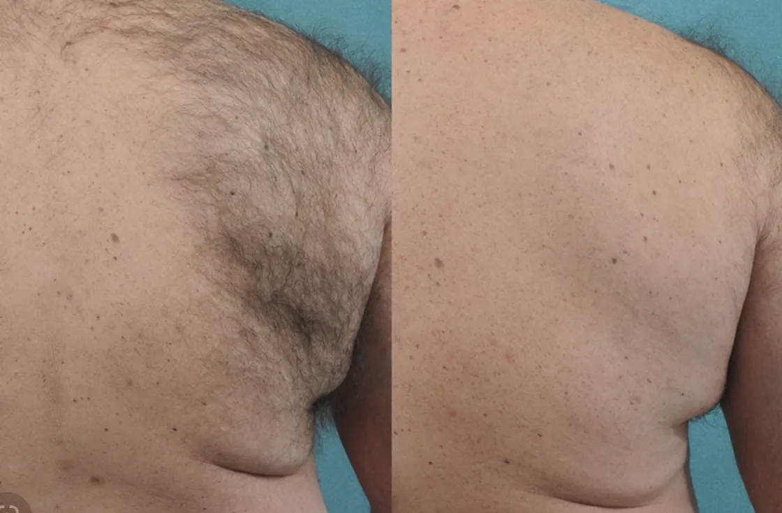 Renual Medspa laser hair removal before and after