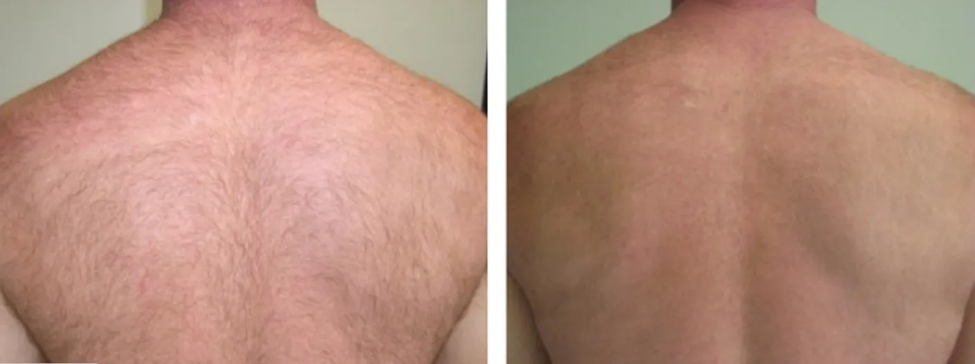 Renual Medspa laser hair removal before and after