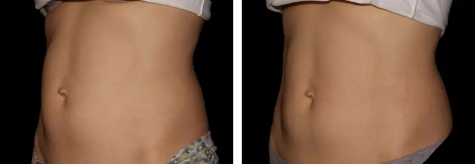 Renual Medspa emsculpt before and after