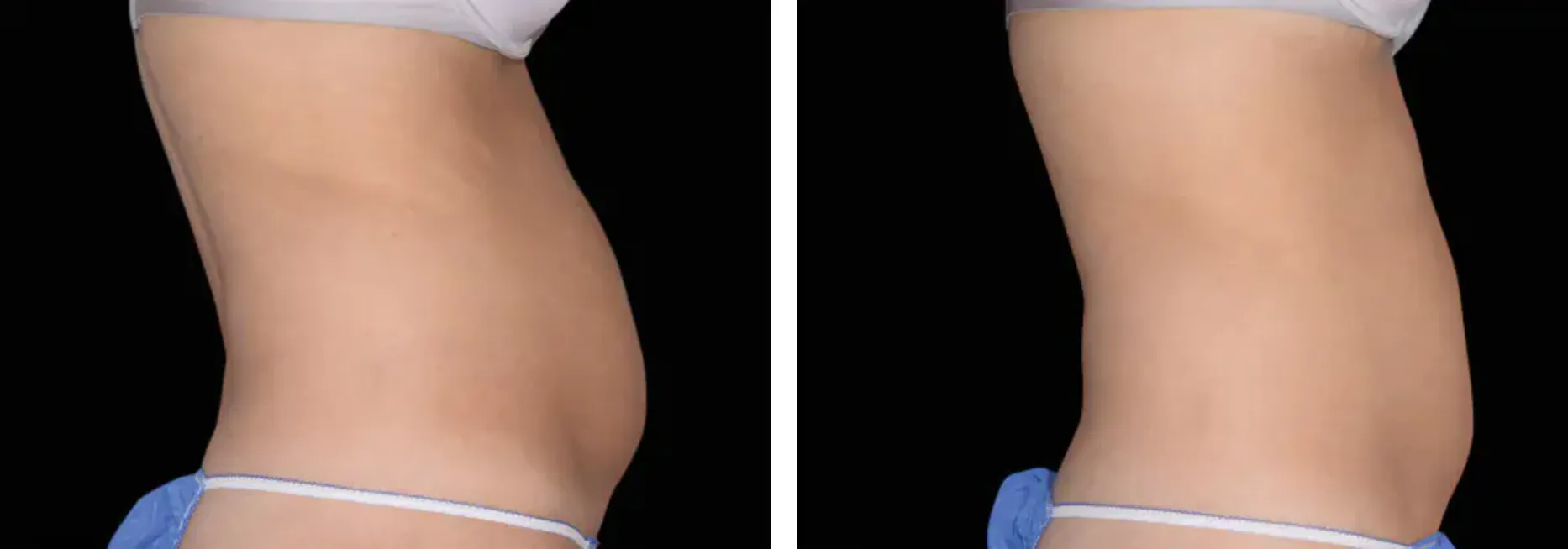Renual Medspa emsculpt before and after
