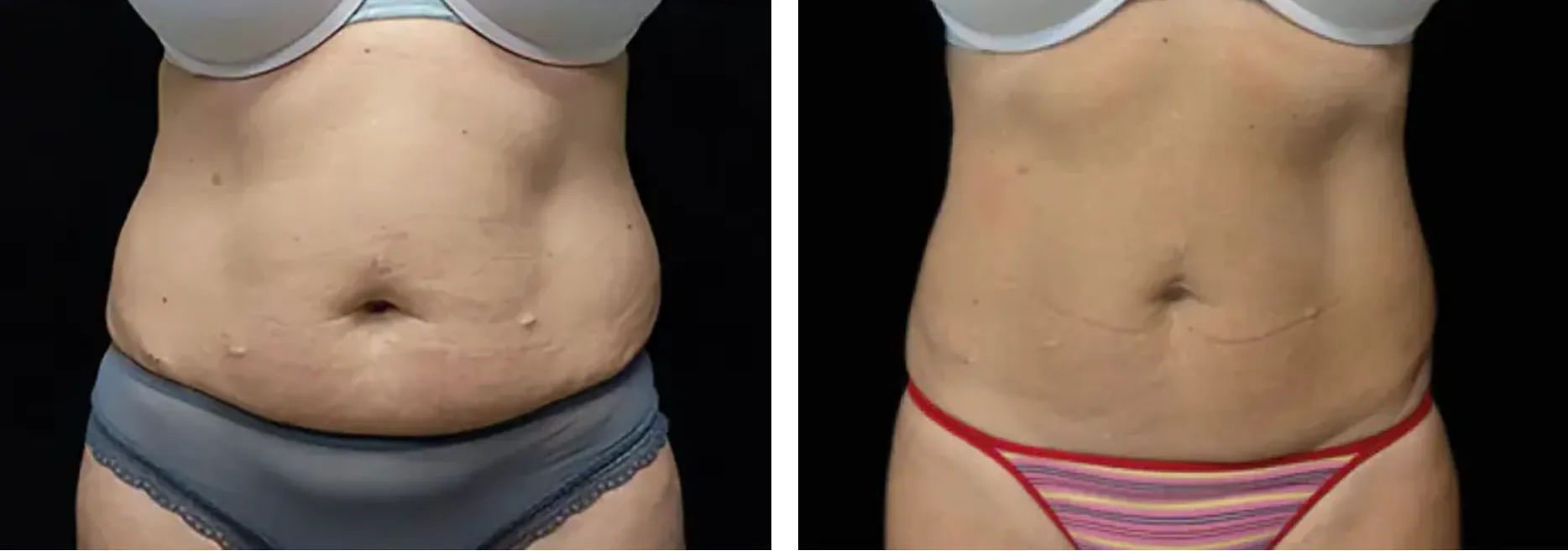 Renual Medspa emsculpt before and after