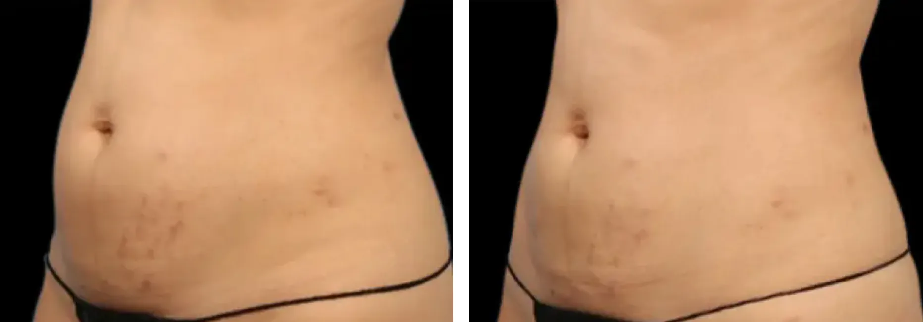 Renual Medspa emsculpt before and after