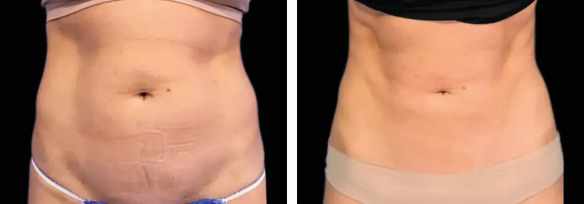 Renual Medspa emsculpt before and after