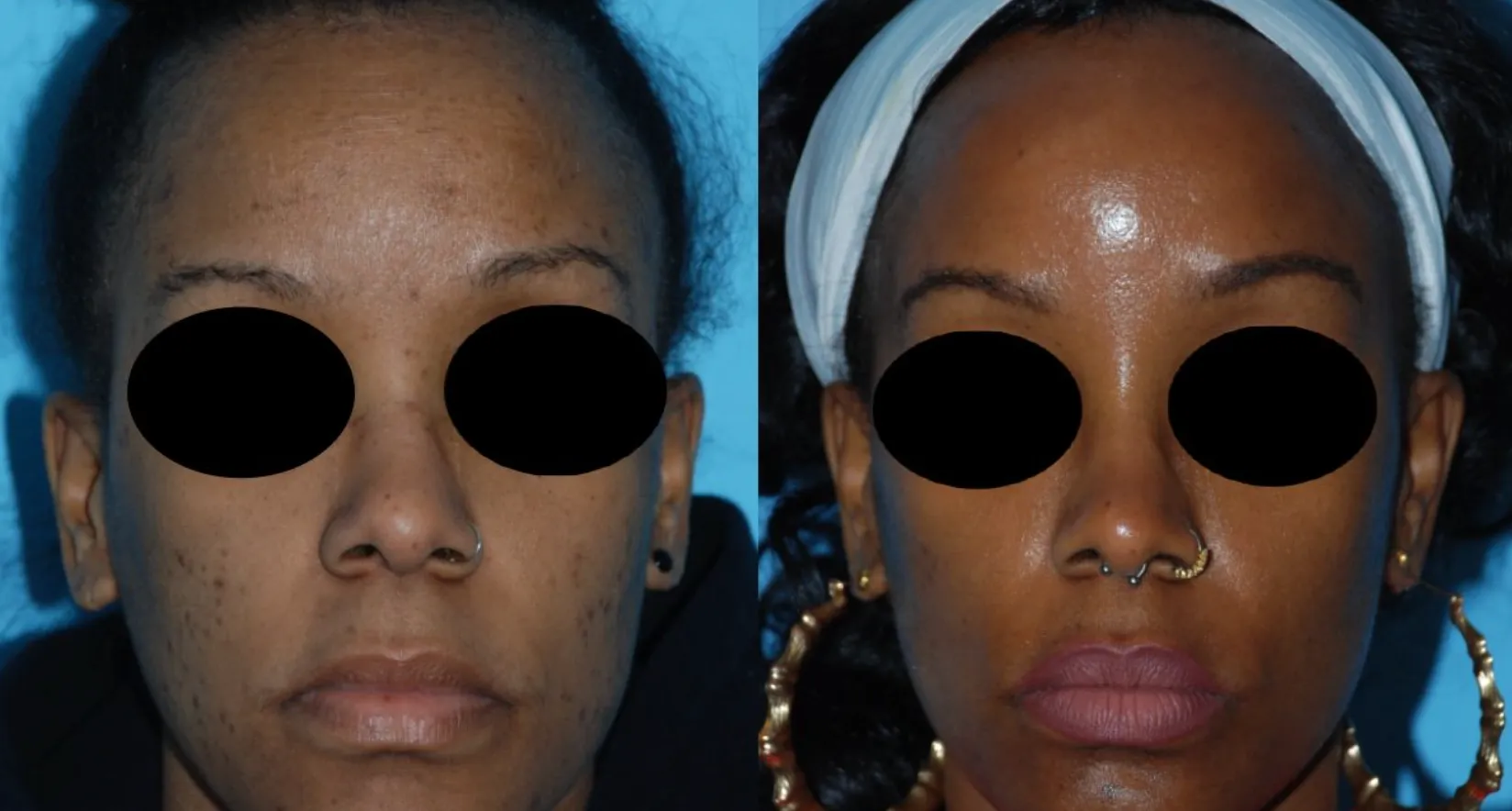 Renual Medspa aerolase before and after