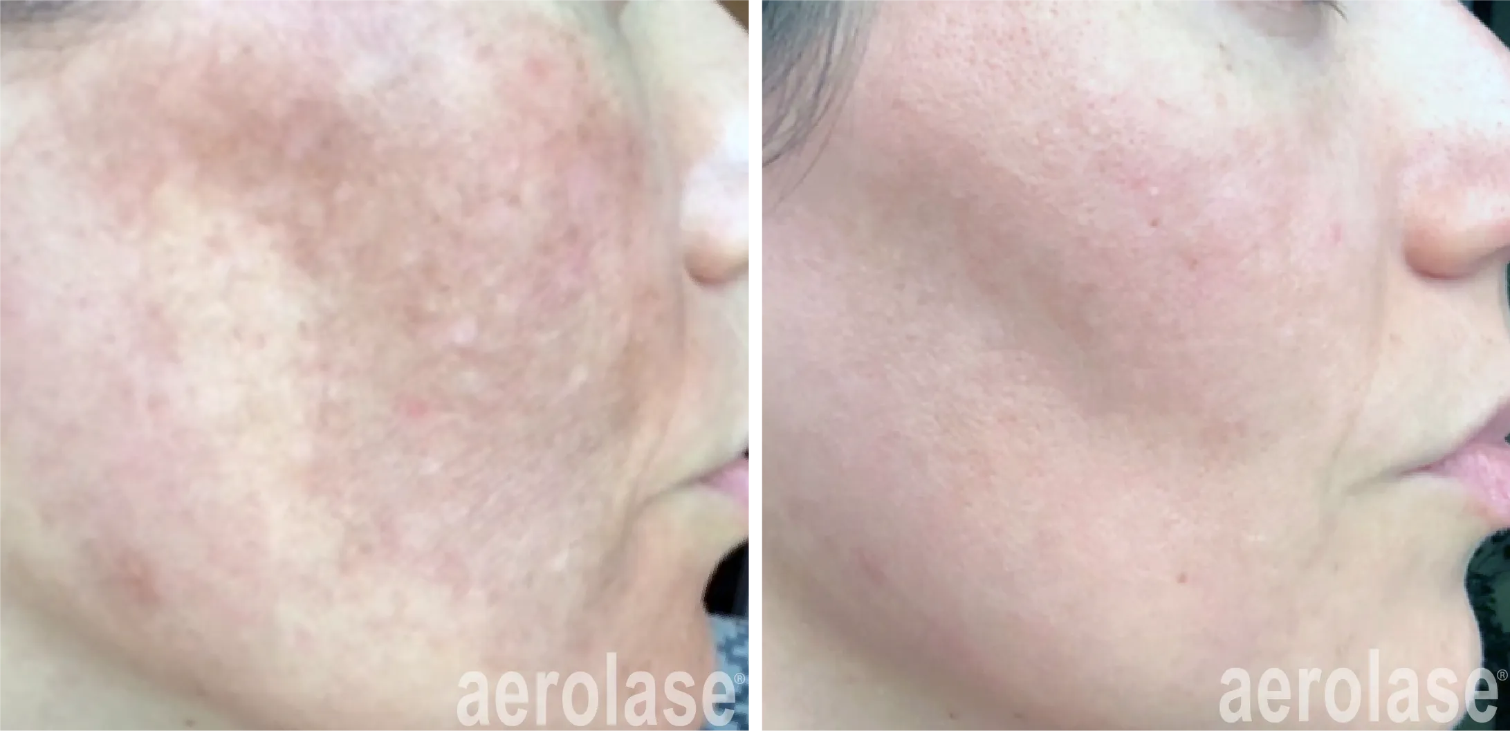 Renual Medspa aerolase before and after