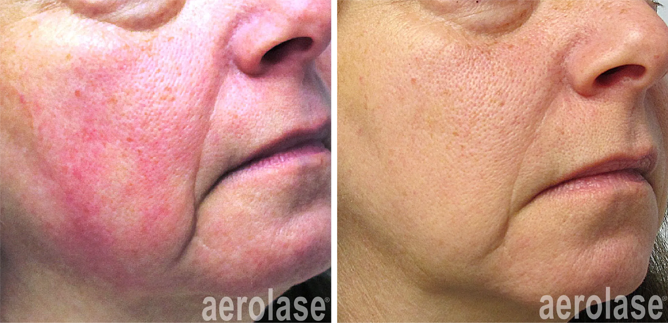 Renual Medspa aerolase before and after