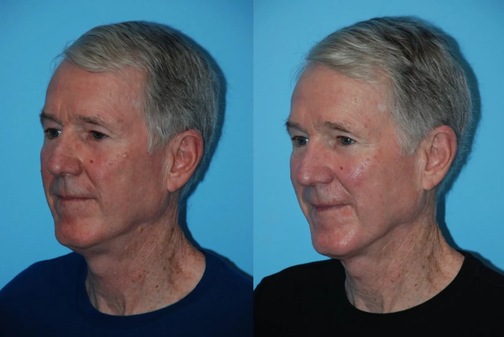 Renual Medspa aerolase before and after