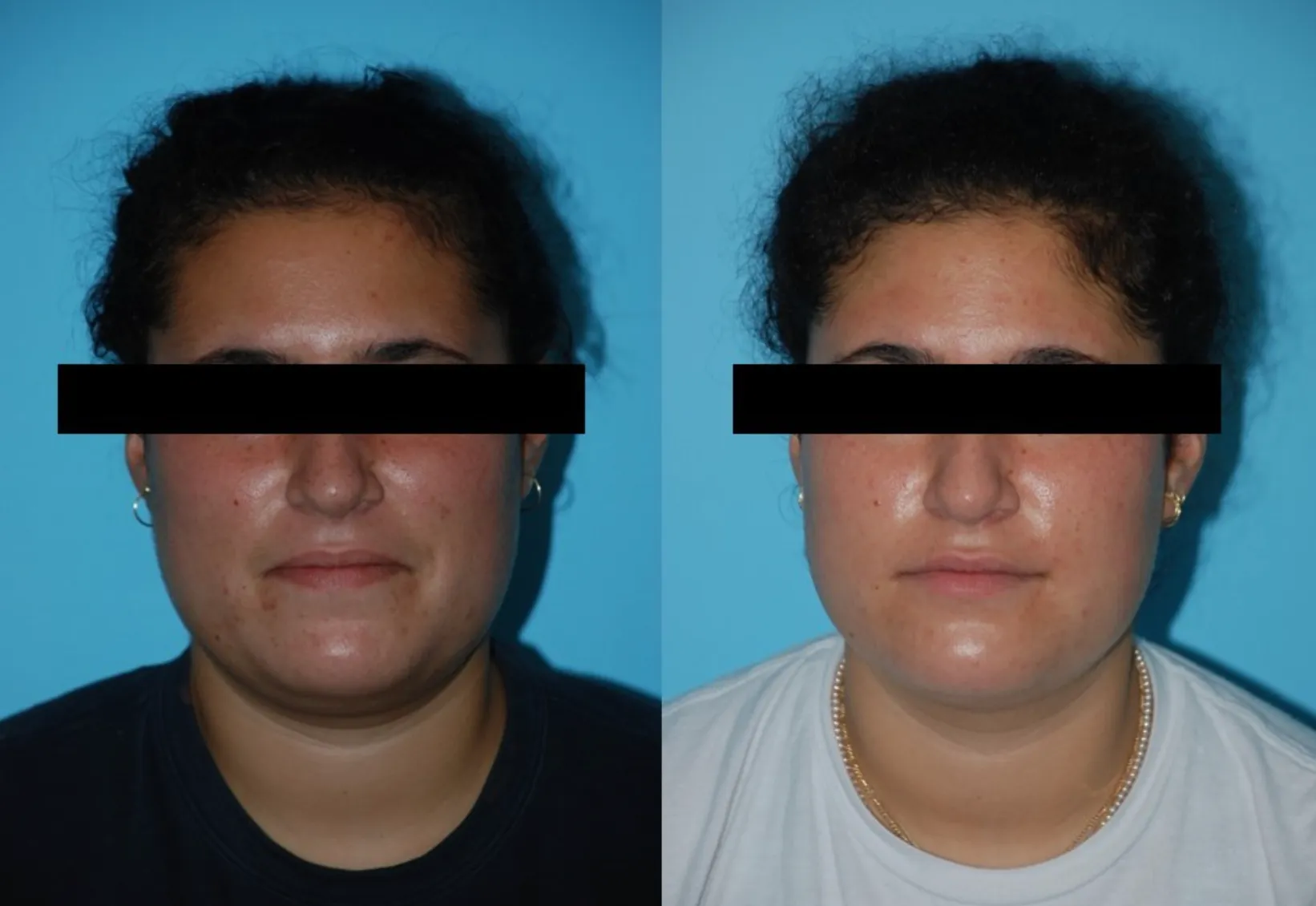 Renual Medspa aerolase before and after