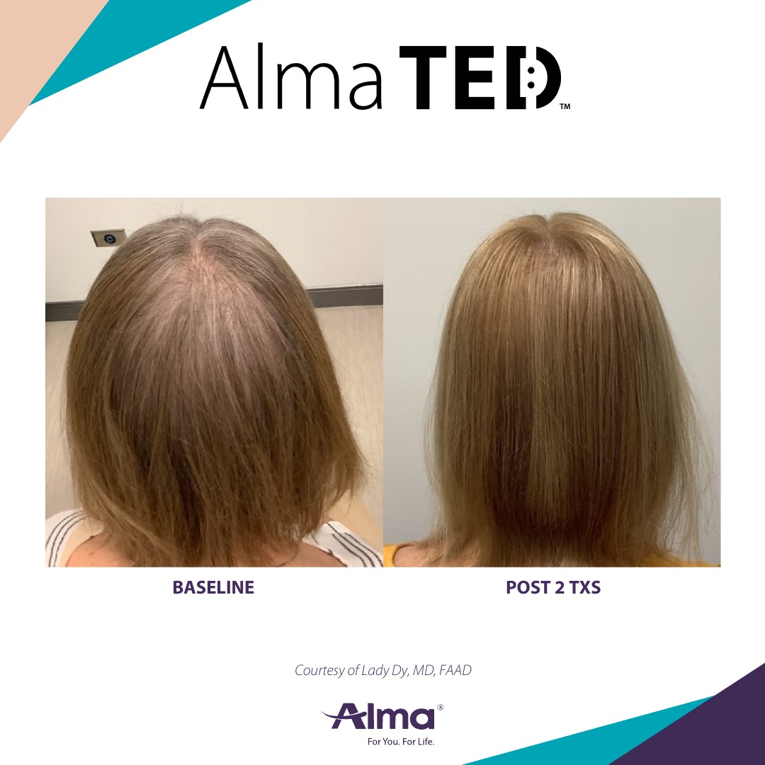 Before and after TED hair restoration results for client 8 at Healthy Living Medical in Texarkana, TX
