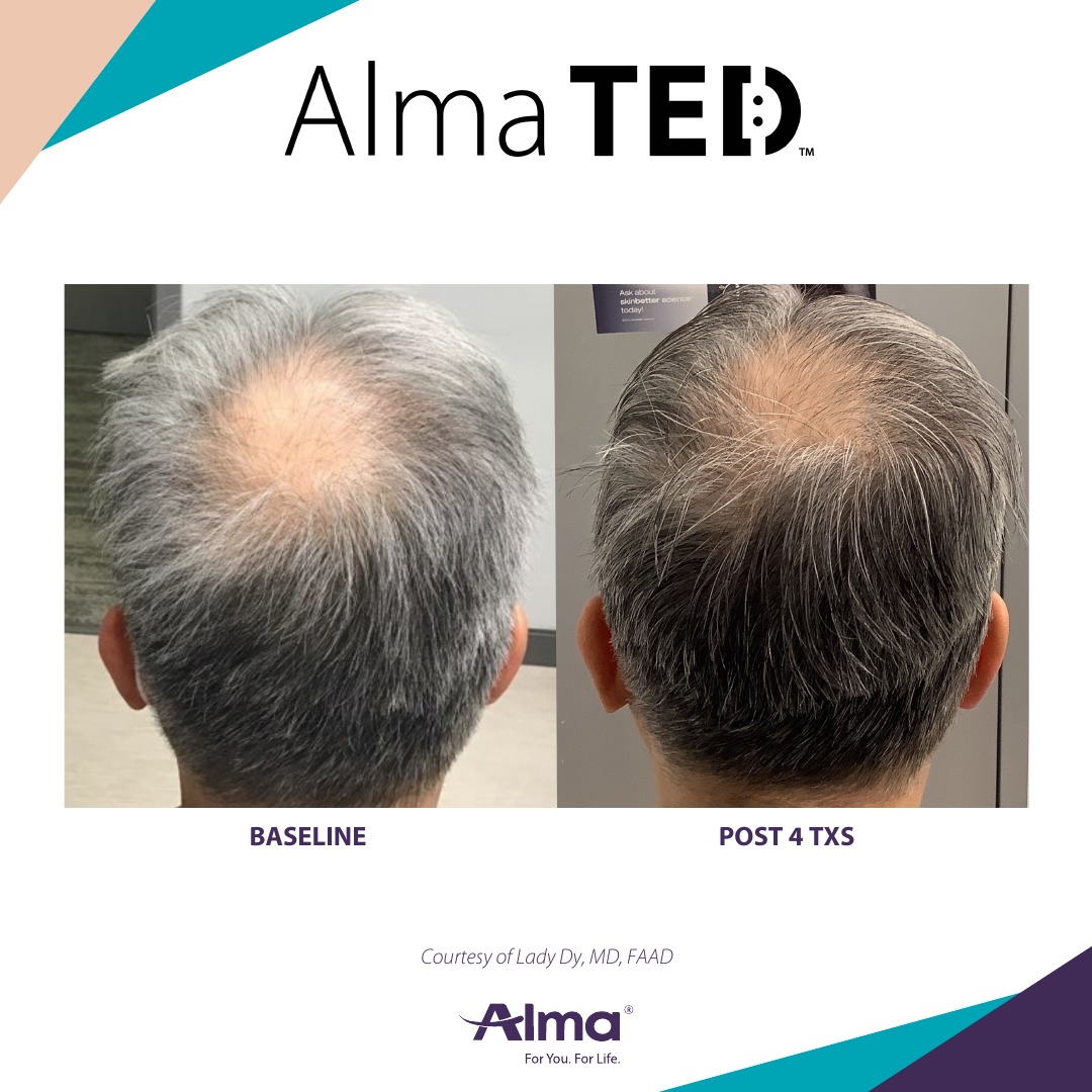 Before and after TED hair restoration results for client 10 at Healthy Living Medical in Texarkana, TX