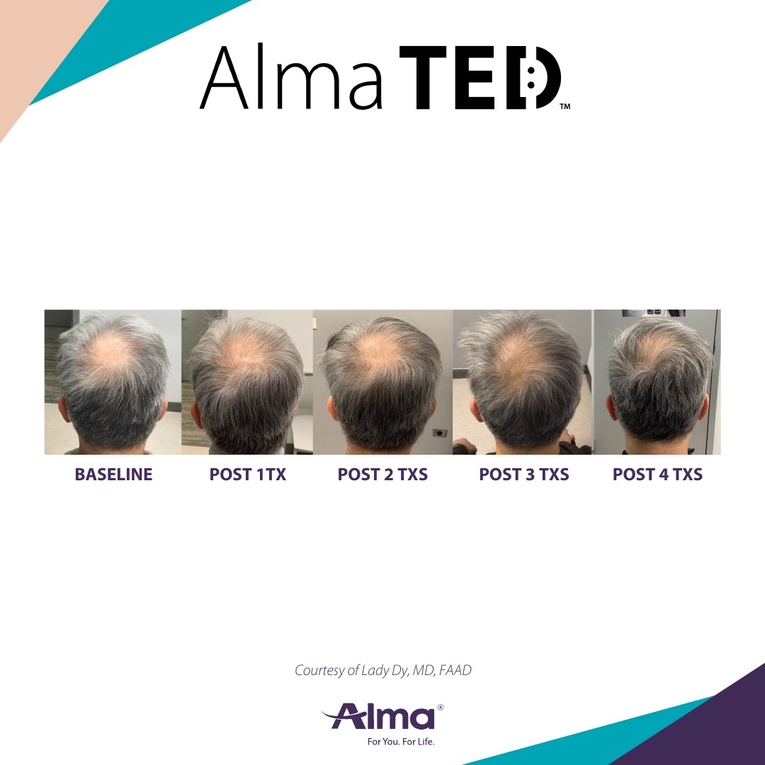 Before and after TED hair restoration results for client 11 at Healthy Living Medical in Texarkana, TX
