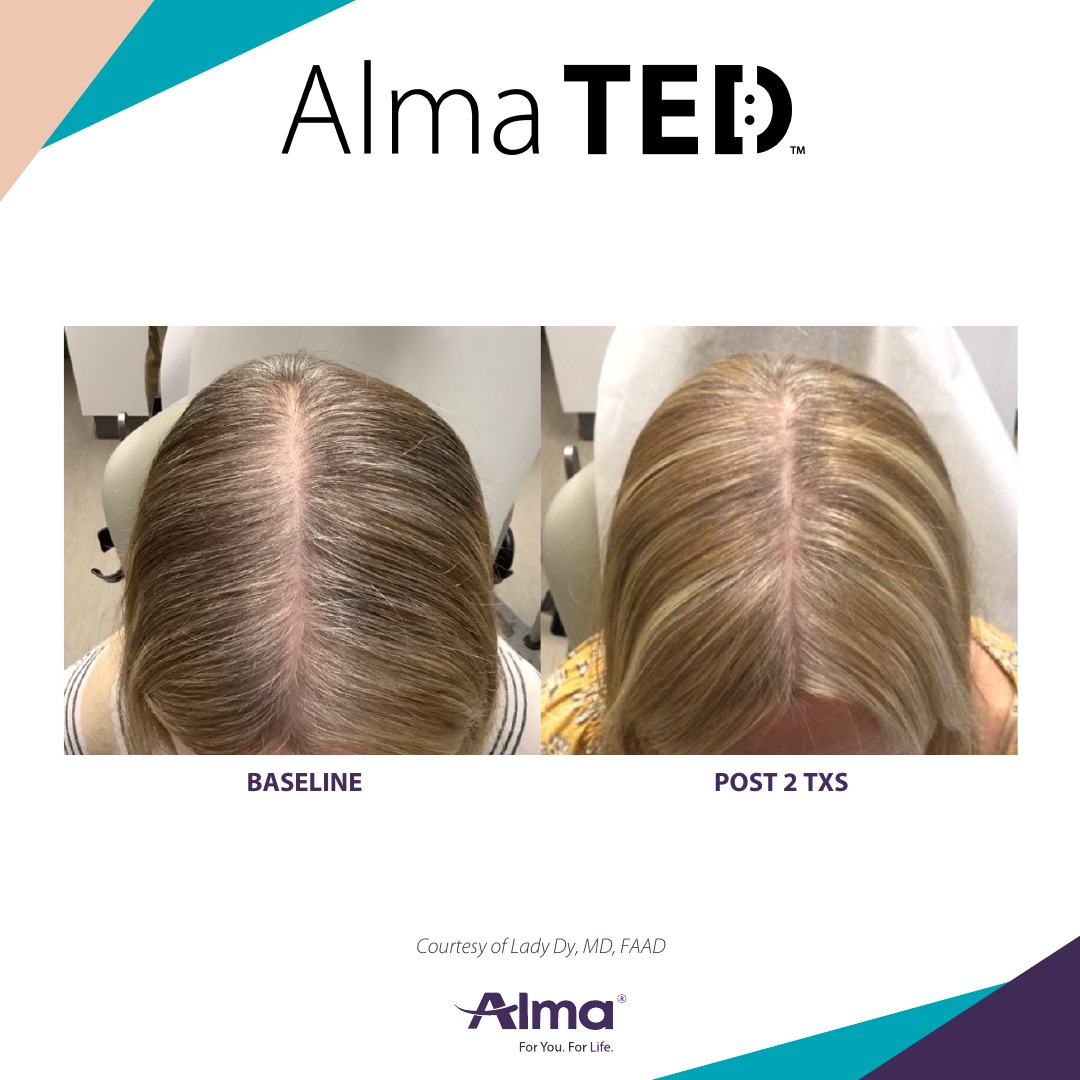 Before and after TED hair restoration results for client 9 at Healthy Living Medical in Texarkana, TX