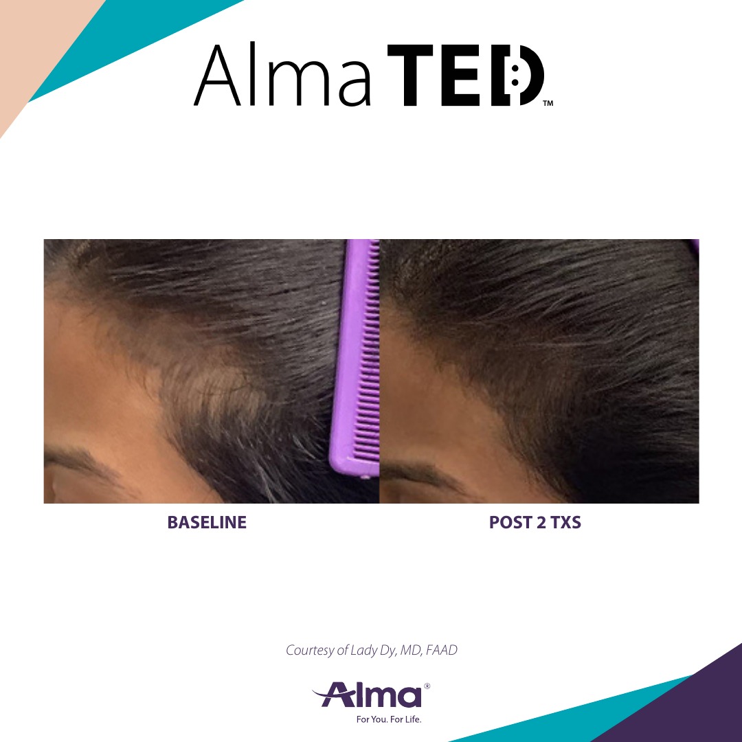 Before and after TED hair restoration results for client 12 at Healthy Living Medical in Texarkana, TX