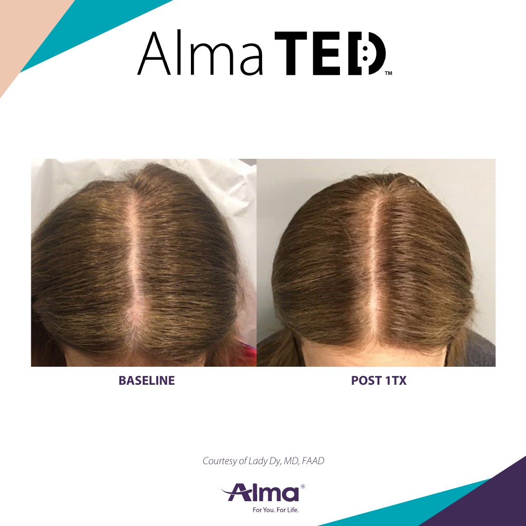 Before and after TED hair restoration results for client 13 at Healthy Living Medical in Texarkana, TX