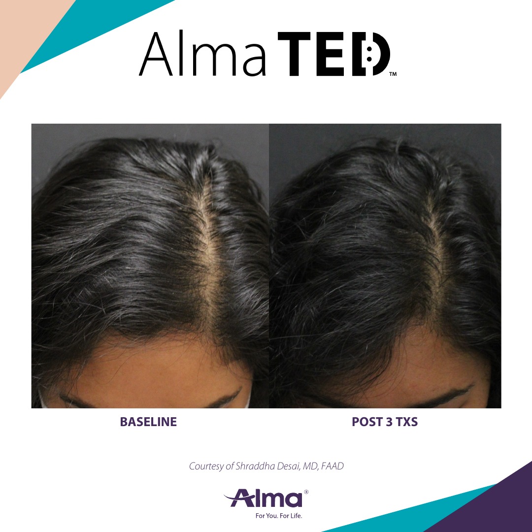 Before and after TED hair restoration results for client 14 at Healthy Living Medical in Texarkana, TX