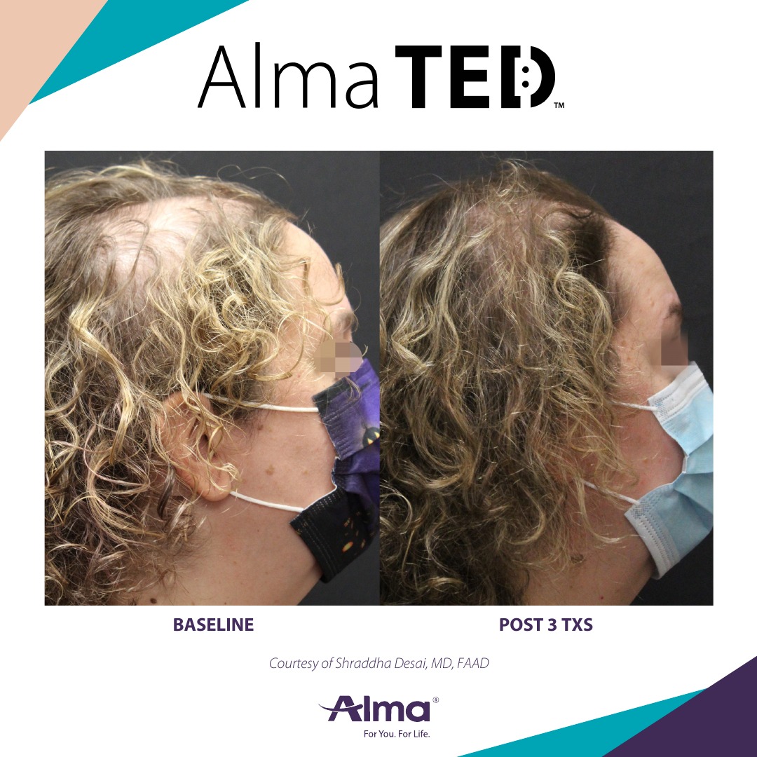 Before and after TED hair restoration results for client 16 at Healthy Living Medical in Texarkana, TX