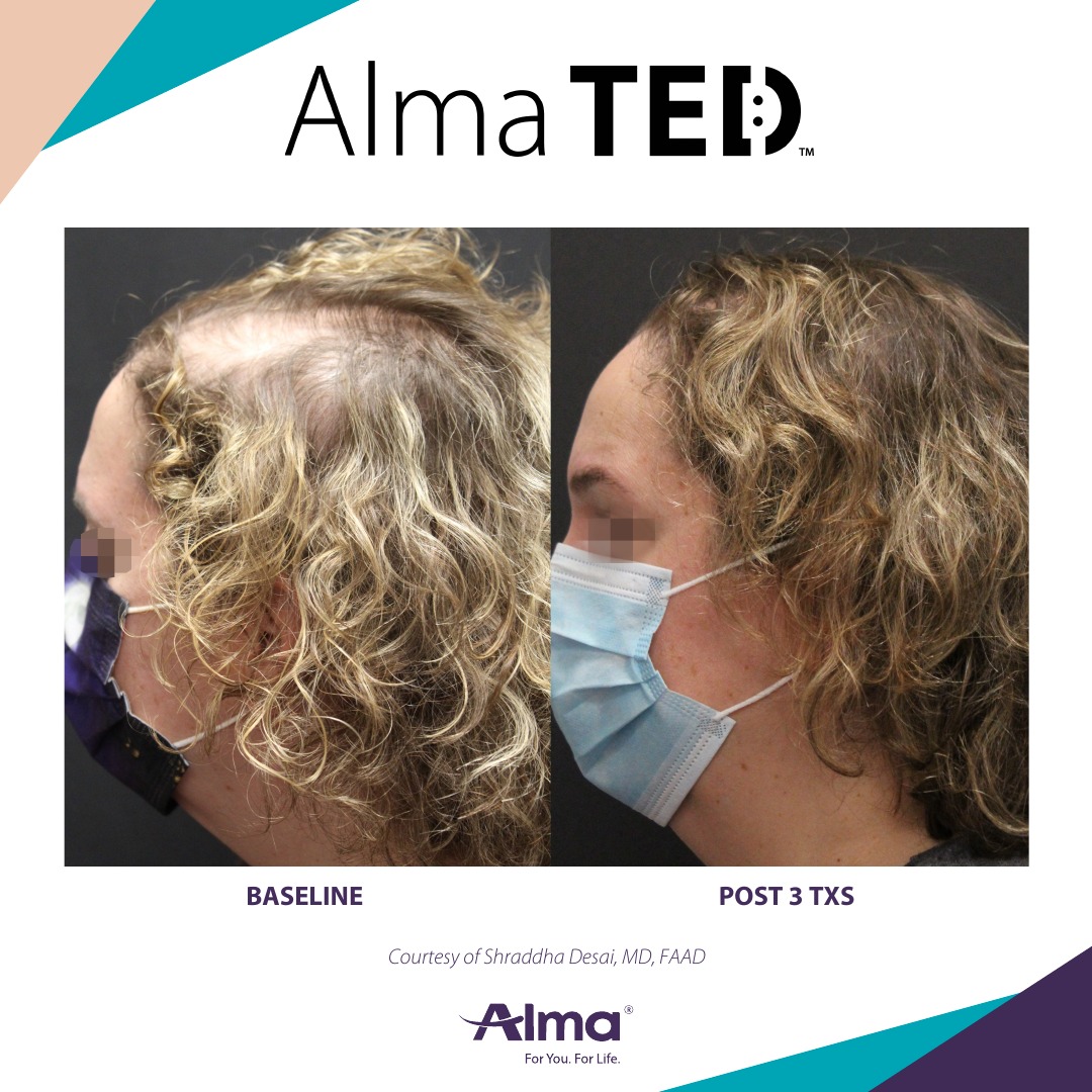 Before and after TED hair restoration results for client 15 at Healthy Living Medical in Texarkana, TX