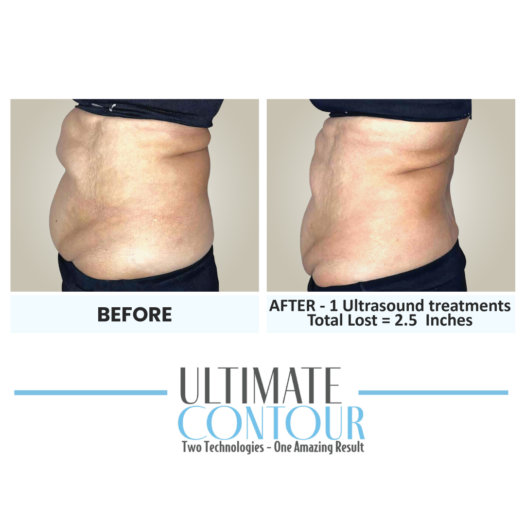 Before and after Ultimate Contour body contouring results for client 5 at Healthy Living Medical in Texarkana, TX