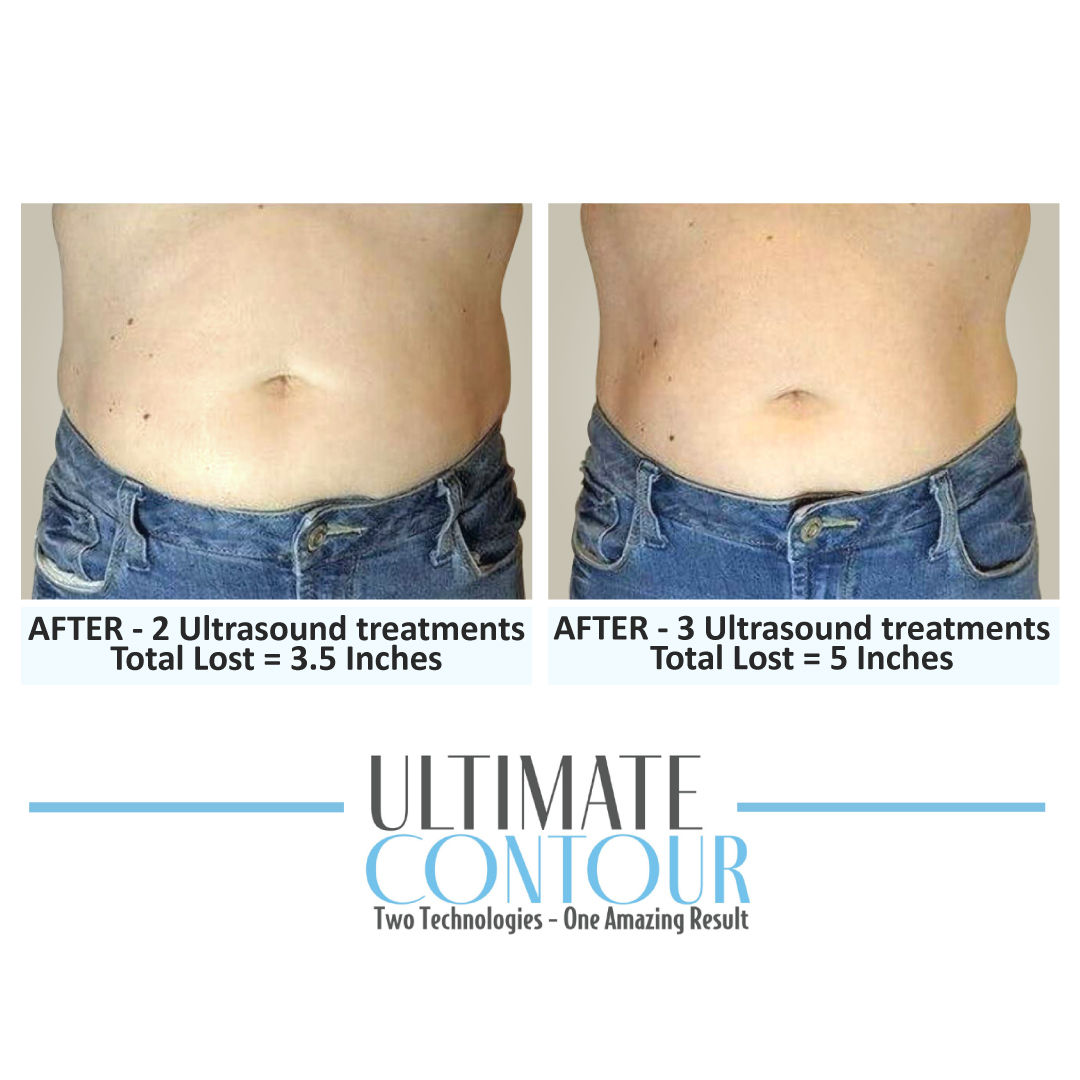 Before and after Ultimate Contour body contouring results for client 3 at Healthy Living Medical in Texarkana, TX