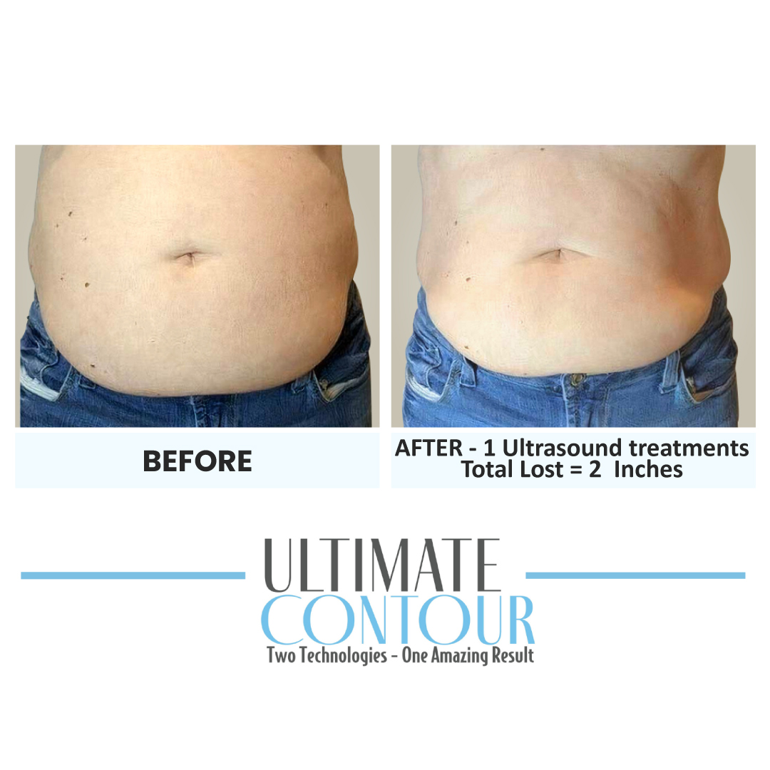 Before and after Ultimate Contour body contouring results for client 2 at Healthy Living Medical in Texarkana, TX