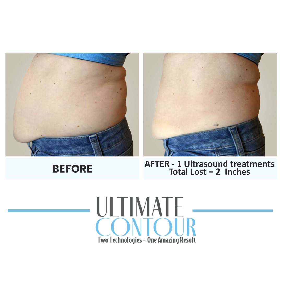 Before and after Ultimate Contour body contouring results for client 1 at Healthy Living Medical in Texarkana, TX