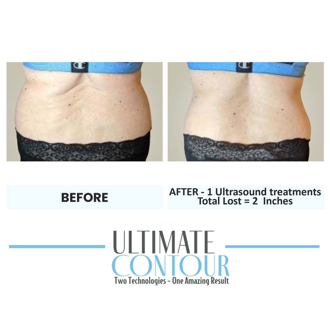 Before and after Ultimate Contour body contouring results for client 4 at Healthy Living Medical in Texarkana, TX
