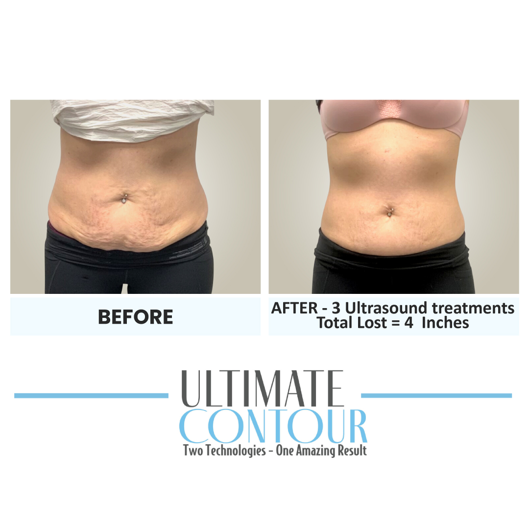 Before and after Ultimate Contour body contouring results for client 6 at Healthy Living Medical in Texarkana, TX