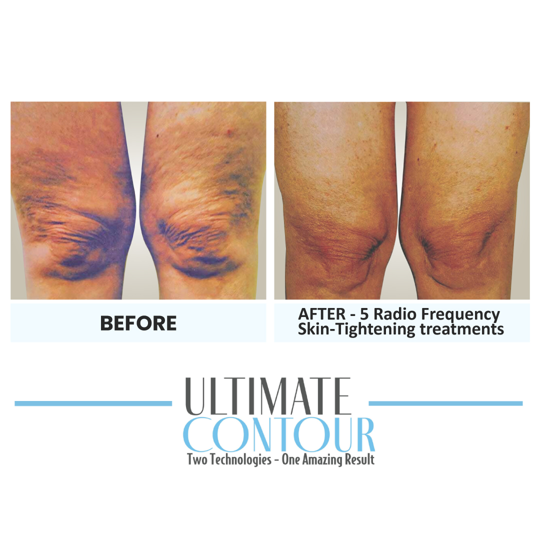 Before and after Ultimate Contour body contouring results for client 10 at Healthy Living Medical in Texarkana, TX