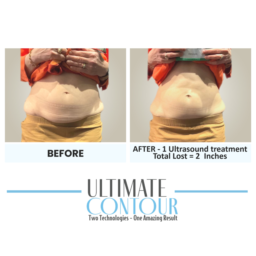 Before and after Ultimate Contour body contouring results for client 11 at Healthy Living Medical in Texarkana, TX