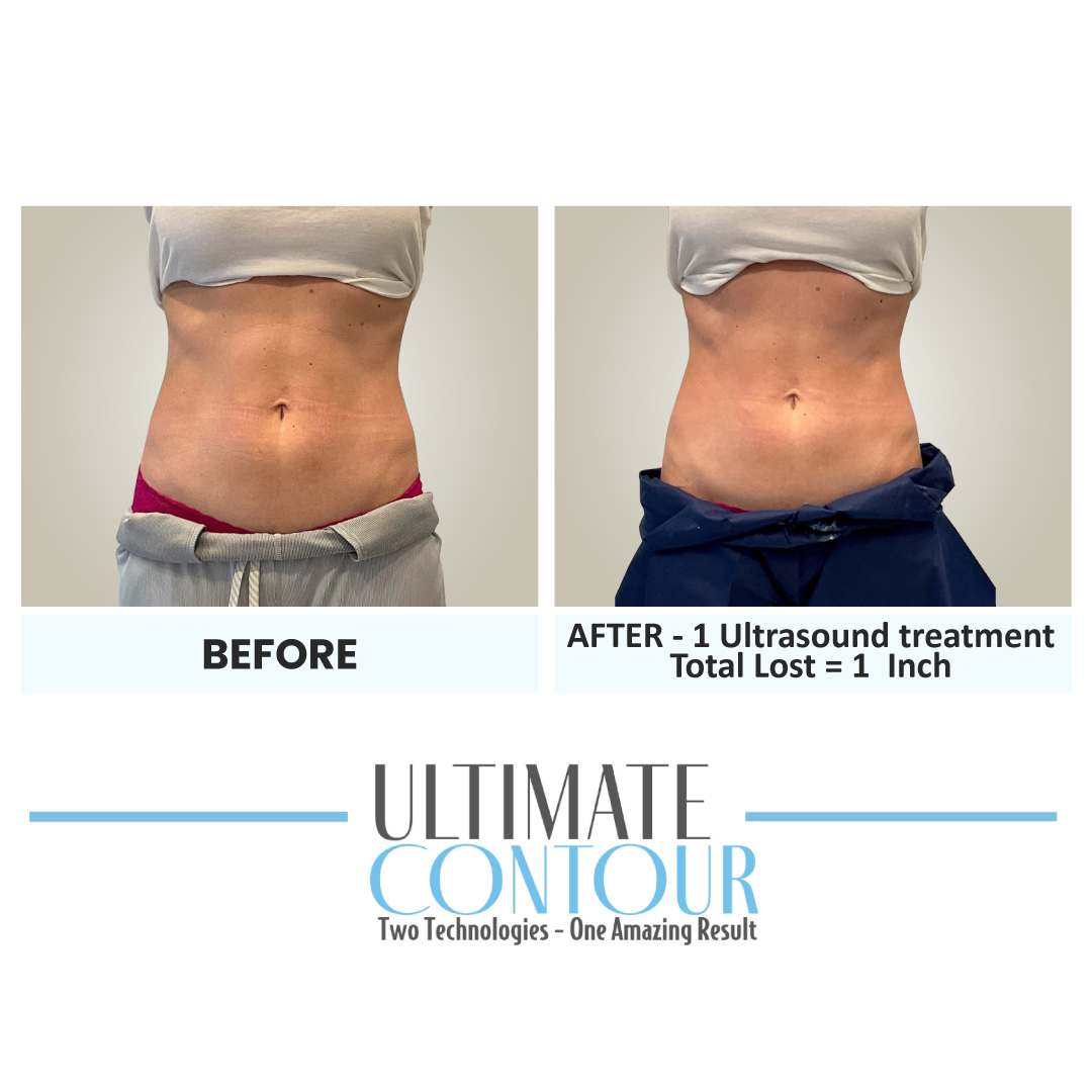 Before and after Ultimate Contour body contouring results for client 7 at Healthy Living Medical in Texarkana, TX