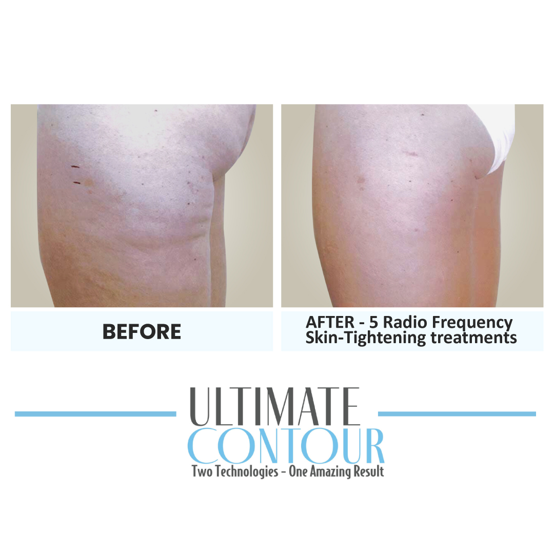 Before and after Ultimate Contour body contouring results for client 9 at Healthy Living Medical in Texarkana, TX