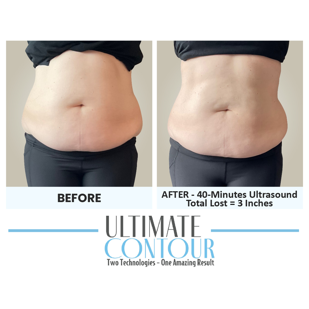 Before and after Ultimate Contour body contouring results for client 8 at Healthy Living Medical in Texarkana, TX
