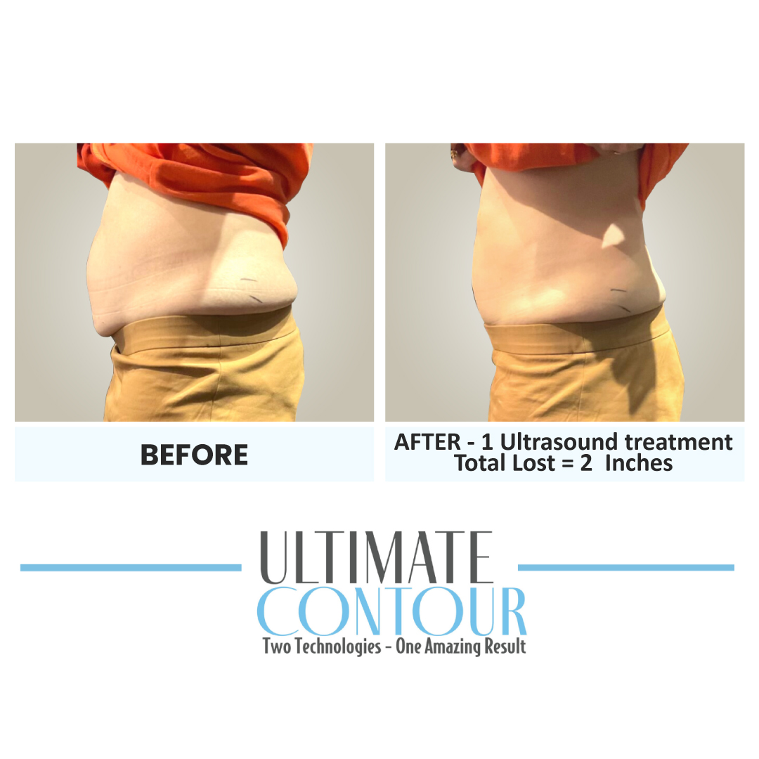 Before and after Ultimate Contour body contouring results for client 12 at Healthy Living Medical in Texarkana, TX