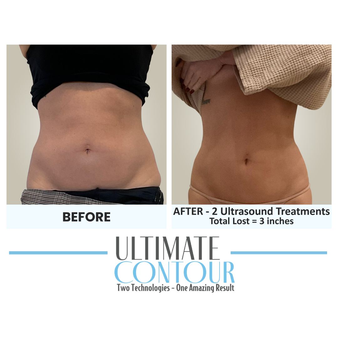 Before and after Ultimate Contour body contouring results for client 13 at Healthy Living Medical in Texarkana, TX