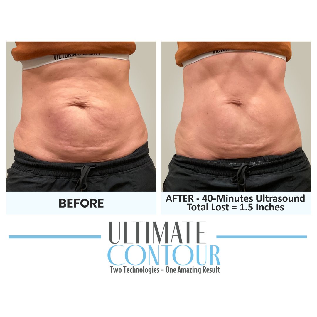 Before and after Ultimate Contour body contouring results for client 18 at Healthy Living Medical in Texarkana, TX